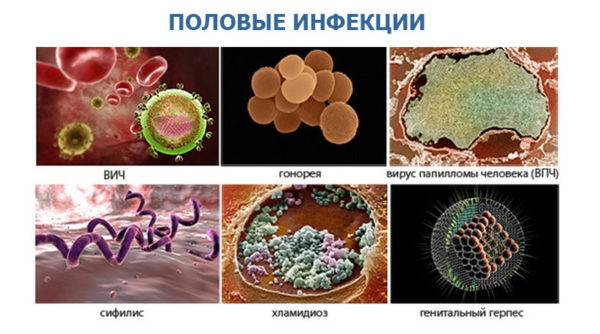 возбудители ЗППП возбудители половых инфекций
