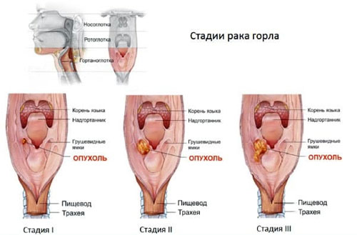 Риска развития рака горла и первые симтопмы