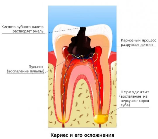 Периодонтит