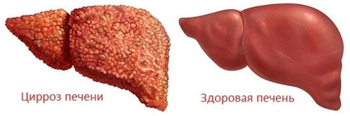 Как воздействует алкоголь на печень