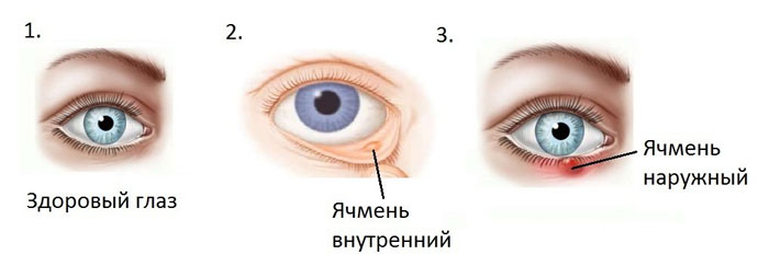 Ячмень на глазу
